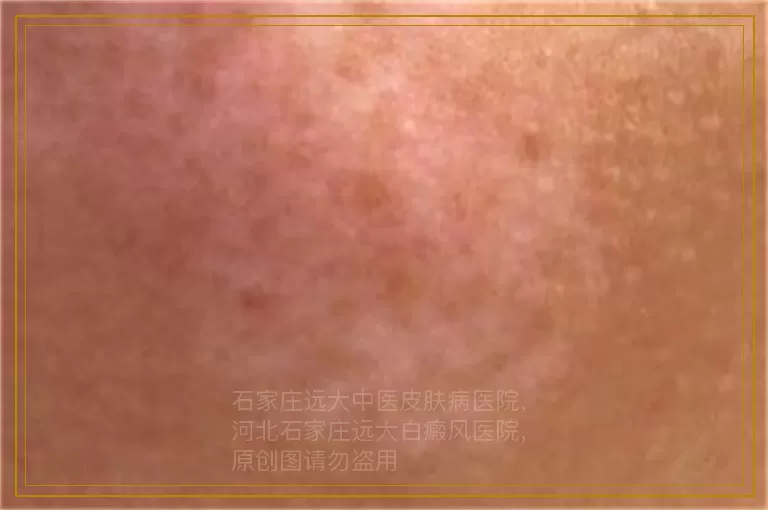 睾丸因白癜风作过激光影响生育吗