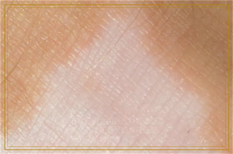 男性白癜风的诱发因素