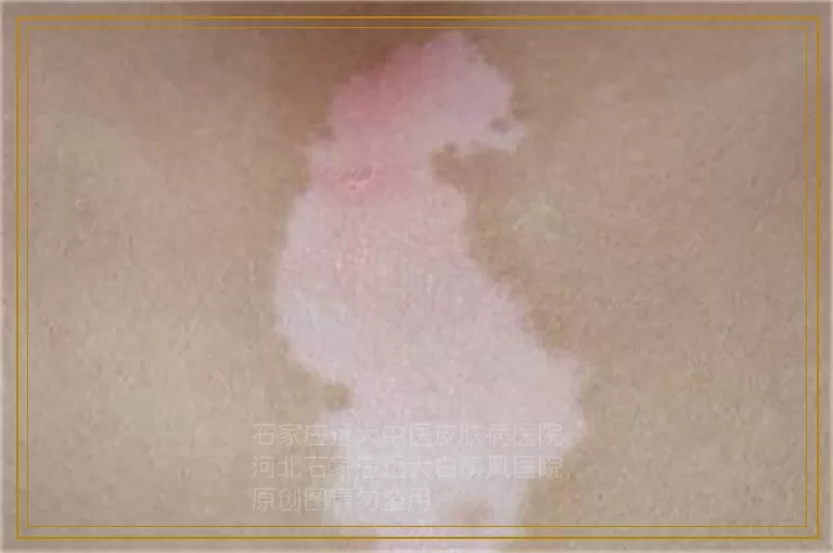 男性白癜风患者如何把握生活中的"尺度"？