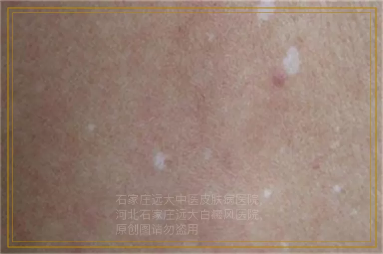 男性长白癜风是什么样的症状