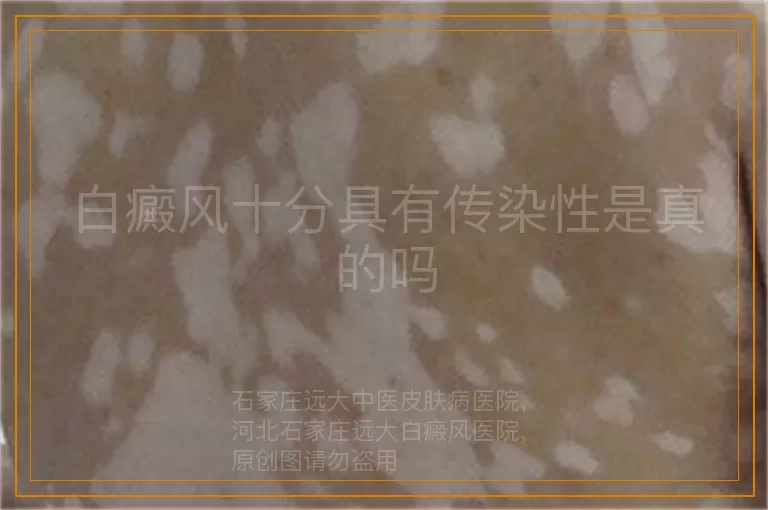 白癜风十分具有传染性是真的吗