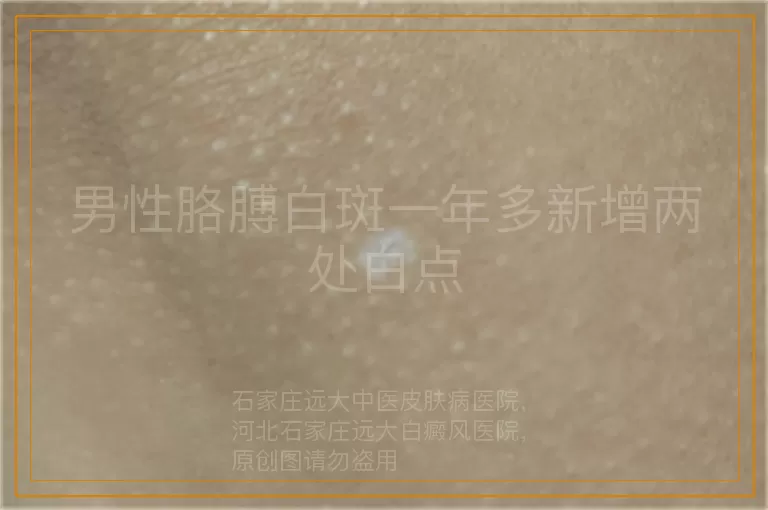 男性胳膊白斑一年多新增两处白点