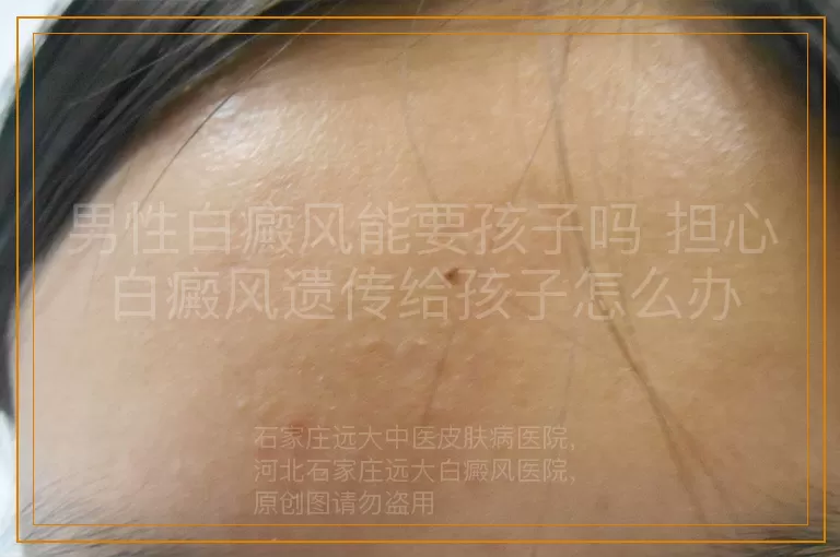 男性白癜风能要孩子吗 担心白癜风遗传给孩子怎么办