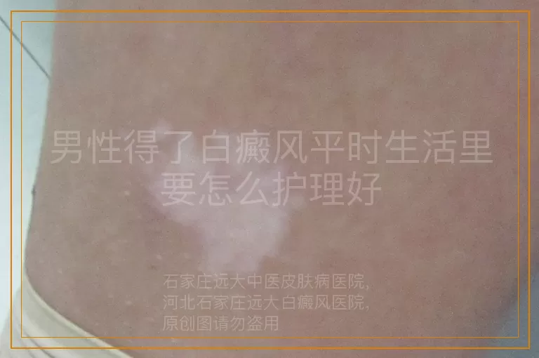 男性得了白癜风平时生活里要怎么护理好