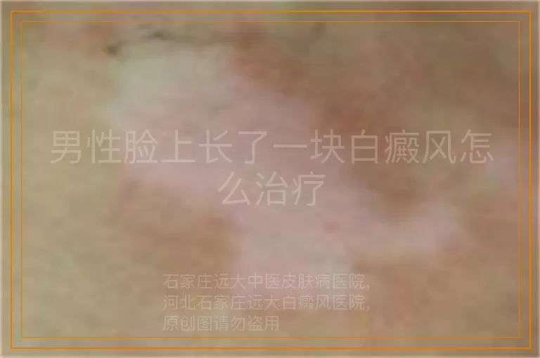 男性脸上长了一块白癜风怎么治疗