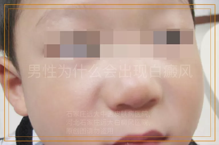 男性为什么会出现白癜风