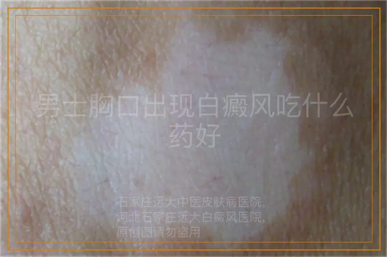 男士胸口出现白癜风吃什么药好