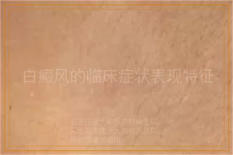 白癜风的临床症状表现特征