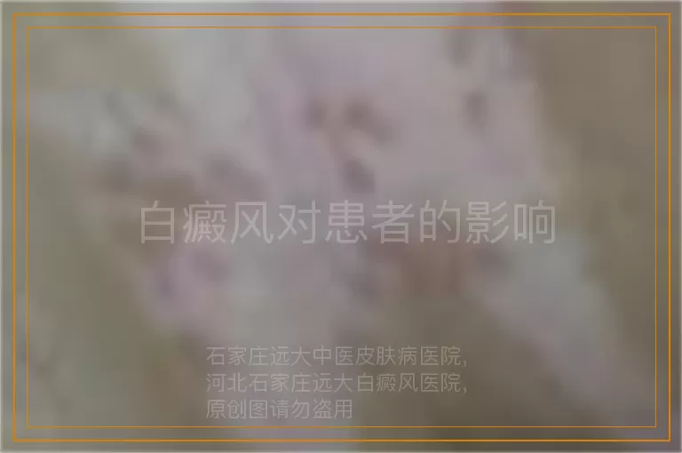 白癜风对患者的影响