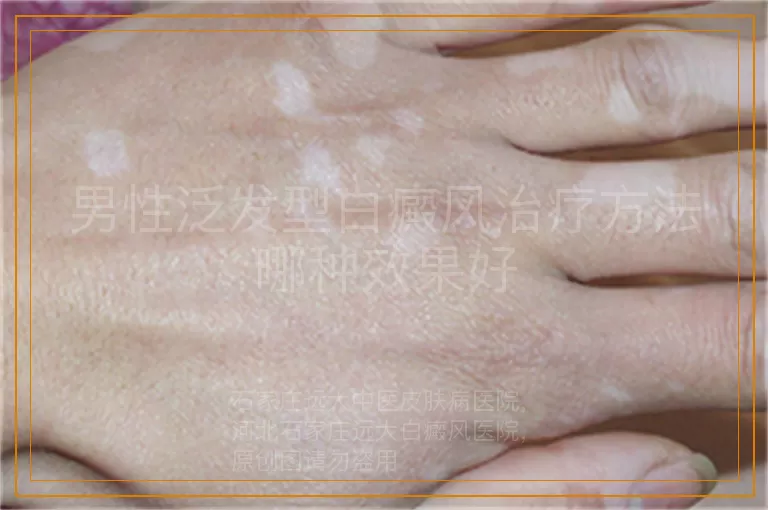 男性泛发型白癜风治疗方法哪种效果好