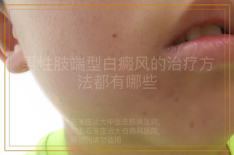 男性肢端型白癜风的治疗方法都有哪些