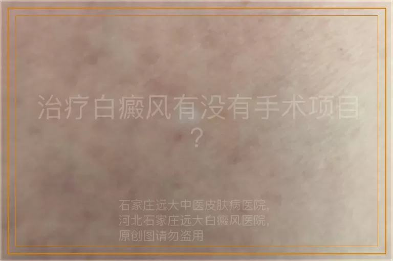 治疗白癜风有没有手术项目？
