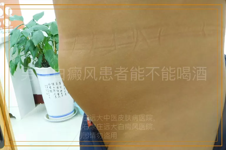 男性白癜风患者能不能喝酒