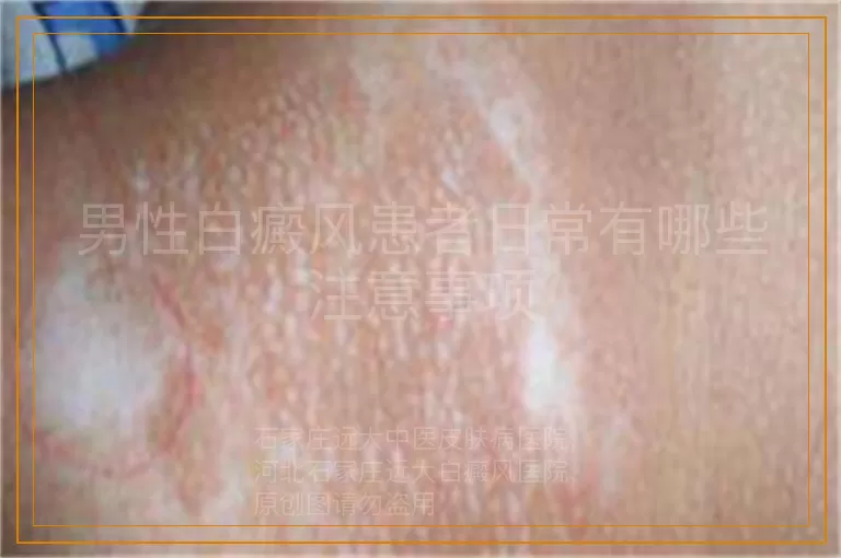 男性白癜风患者日常有哪些注意事项