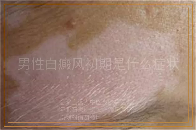 男性白癜风初期是什么症状