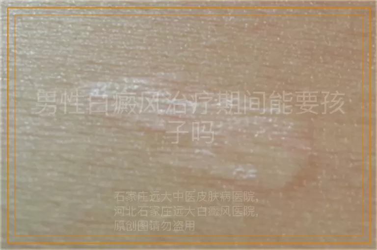 男性白癜风治疗期间能要孩子吗