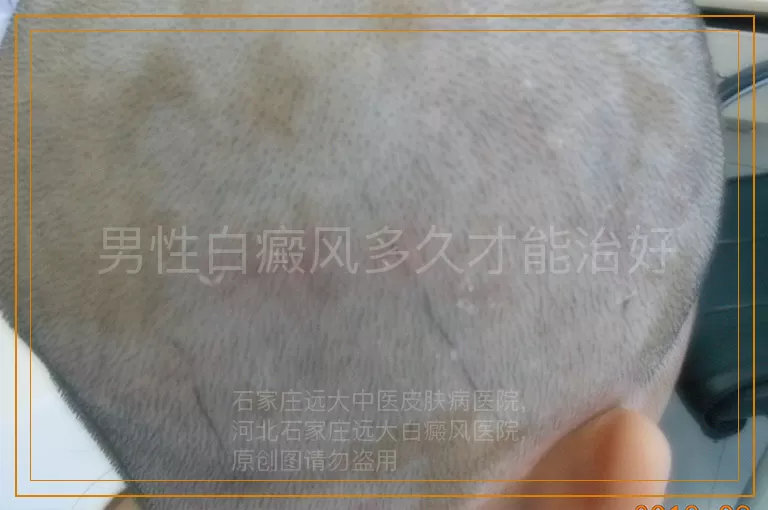 男性白癜风多久才能治好