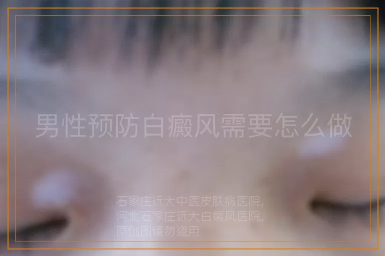 男性预防白癜风需要怎么做