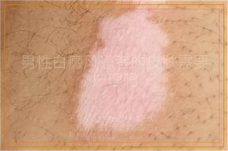 男性白癜风患者的皮肤需要护理吗