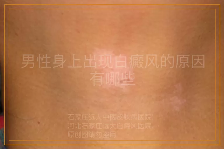 男性身上出现白癜风的原因有哪些