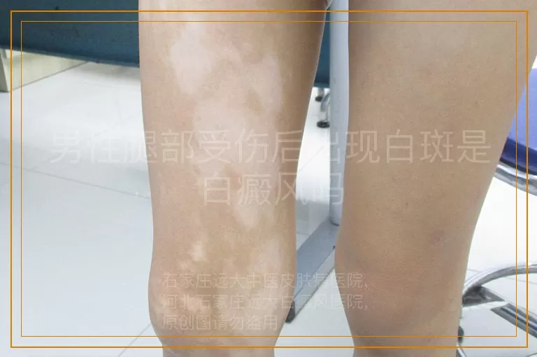 男性腿部受伤后出现白斑是白癜风吗