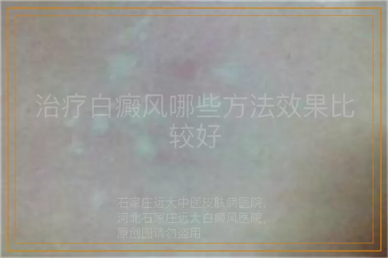 治疗白癜风哪些方法效果比较好