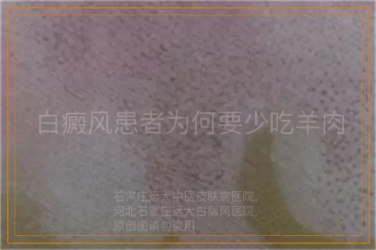 白癜风患者为何要少吃羊肉