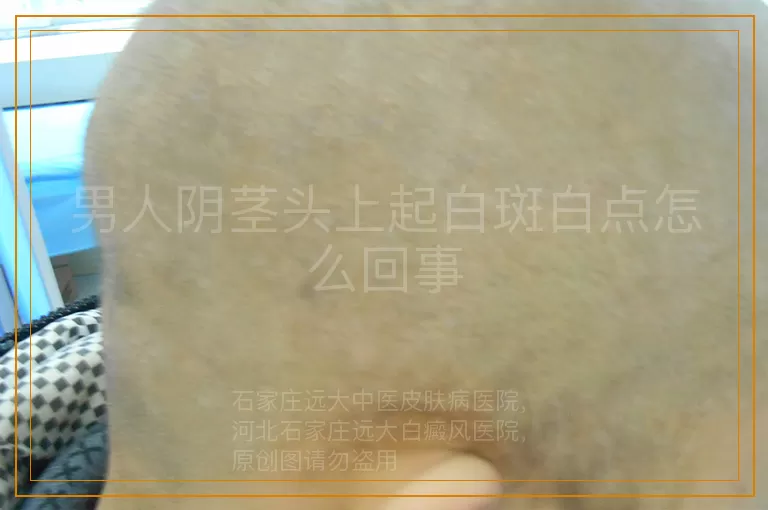 男人阴茎头上起白斑白点怎么回事