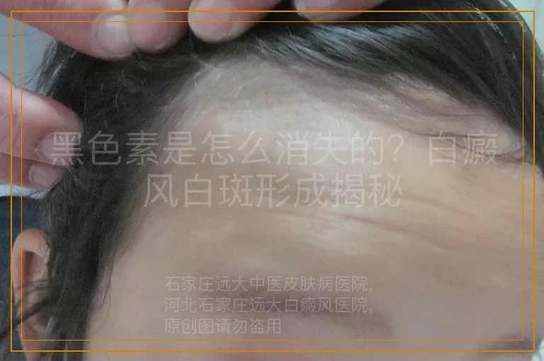 黑色素是怎么消失的？白癜风白斑形成揭秘