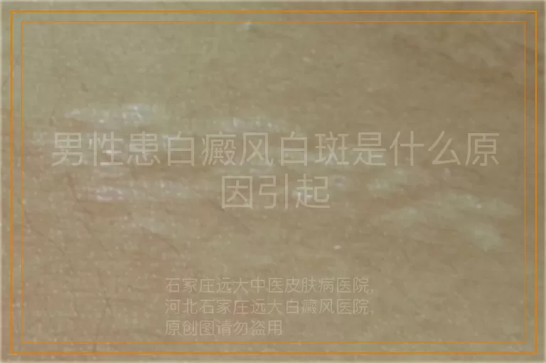 男性患白癜风白斑是什么原因引起
