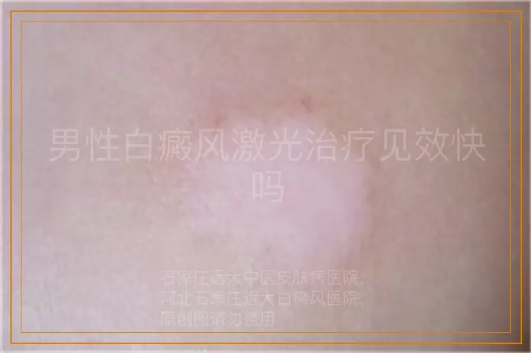 男性白癜风激光治疗见效快吗