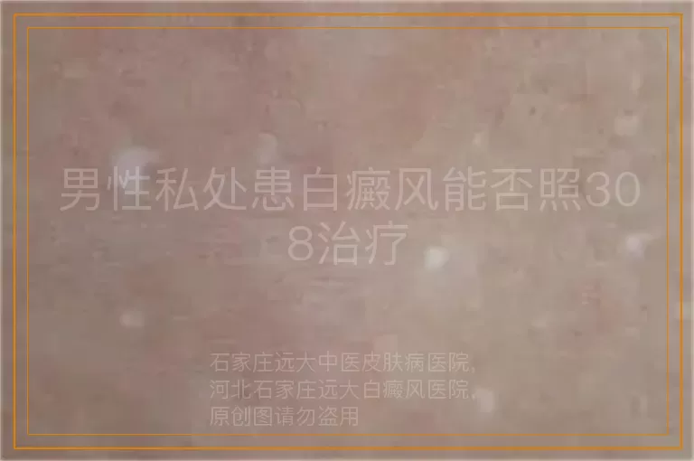 男性私处患白癜风能否照308治疗