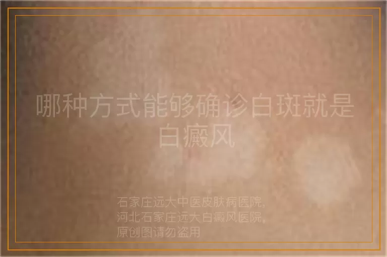 哪种方式能够确诊白斑就是白癜风