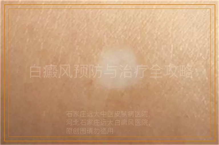 白癜风预防与治疗全攻略