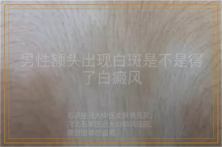 男性额头出现白斑是不是得了白癜风
