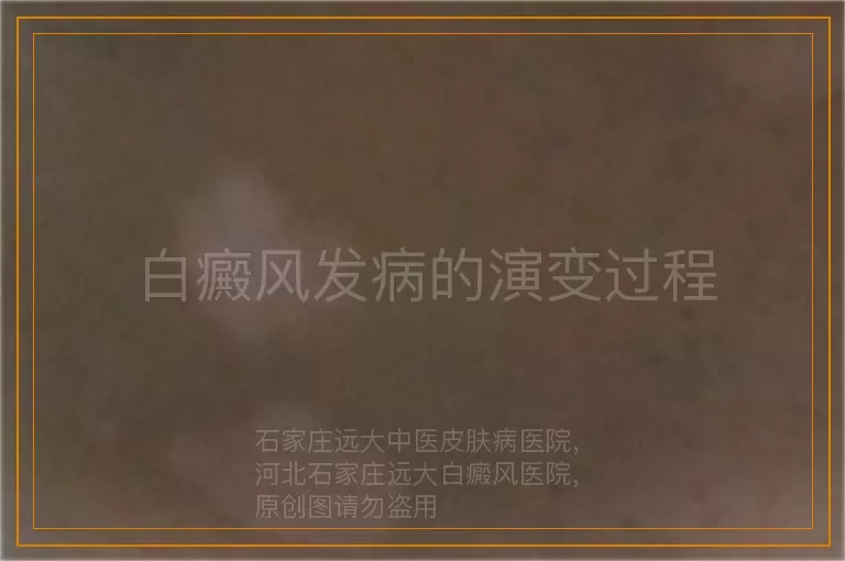 白癜风发病的演变过程