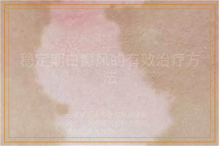 稳定期白癜风的有效治疗方法
