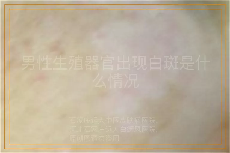 男性生殖器官出现白斑是什么情况