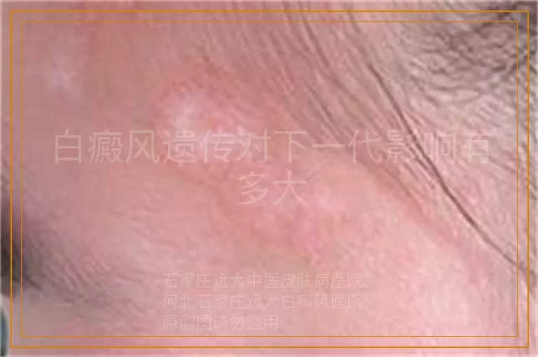 白癜风遗传对下一代影响有多大