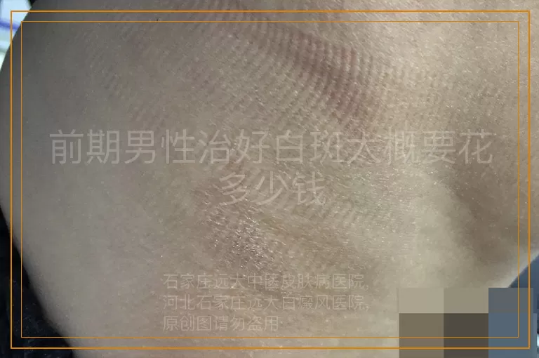 前期男性治好白斑大概要花多少钱