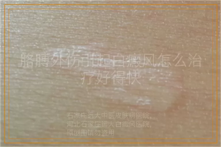 胳膊外伤引起白癜风怎么治疗好得快