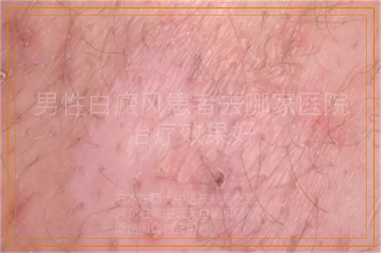 男性白癜风患者去哪家医院治疗效果好