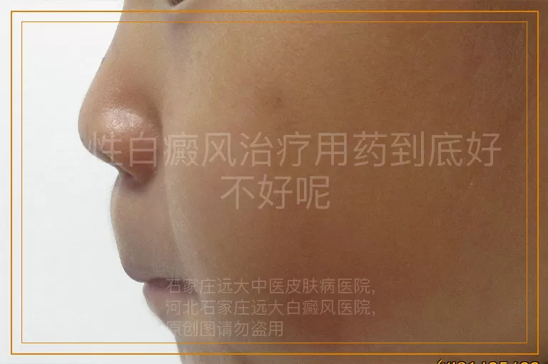 男性白癜风治疗用药到底好不好呢
