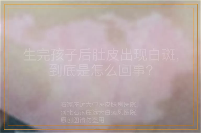 生完孩子后肚皮出现白斑，到底是怎么回事？