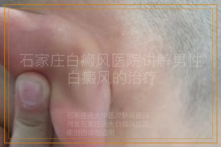 石家庄白癜风医院讲解男性白癜风的治疗