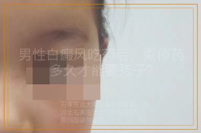 男性白癜风吃药后，需停药多久才能要孩子？