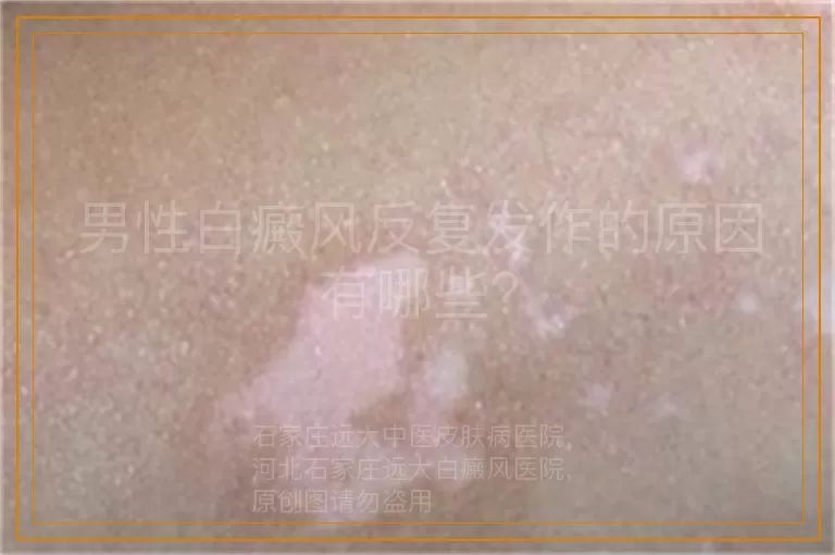 男性白癜风反复发作的原因有哪些？