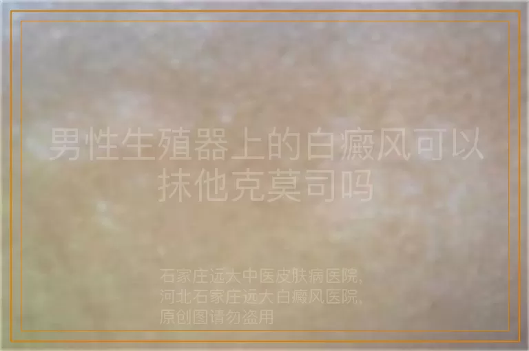 男性生殖器上的白癜风可以抹他克莫司吗