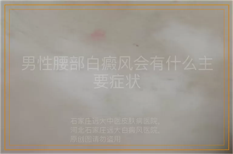 男性腰部白癜风会有什么主要症状