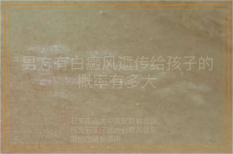 男方有白癜风遗传给孩子的概率有多大